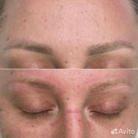 Удаление татуажа и тату лазером и ремувером