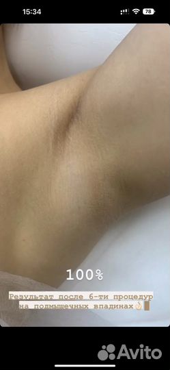 Лазерная эпиляция