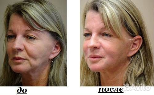 Холодный лифтинг для лица. Плазмолифтинг для лица до и после фото. Результат смас лифтинга спустя месяц. Акне, постакне, пигментация. Плазменный лифтинг лица.