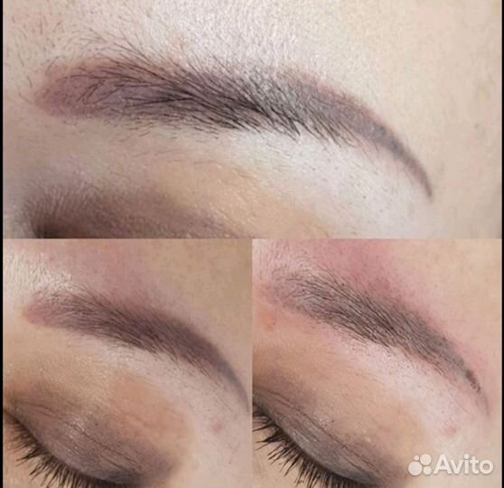 Удаление перманентного макияжа