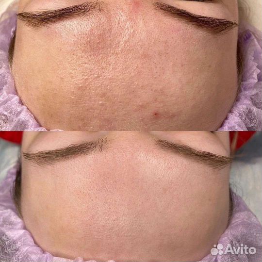 Пилинг biorepeelcl3