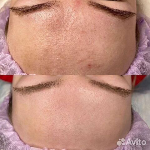 Пилинг biorepeelcl3