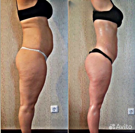 Массаж антицеллюлитный. Уменьшение объемов