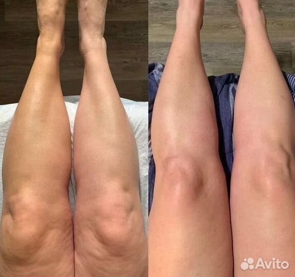 Ищу модель на криолиполиз