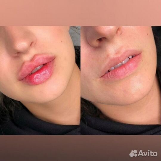 Безыгольное увеличение губ, био,мезо, липолитики