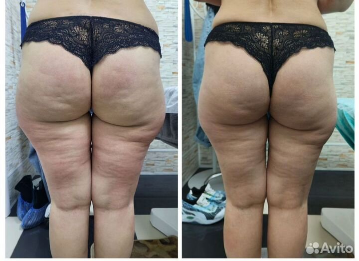 Антицеллюлитный массаж