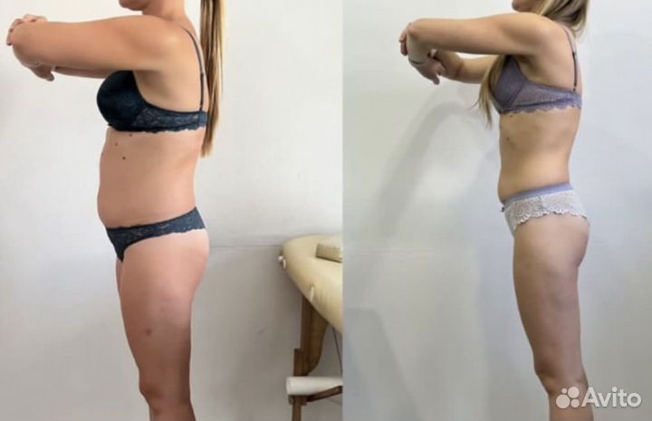 Косметолог - Кавитация, настоящий жиротоп