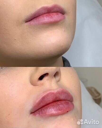 Модель на увеличение губ