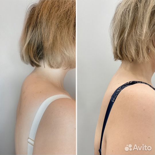 Коррекция фигуры безоперационная липосакция