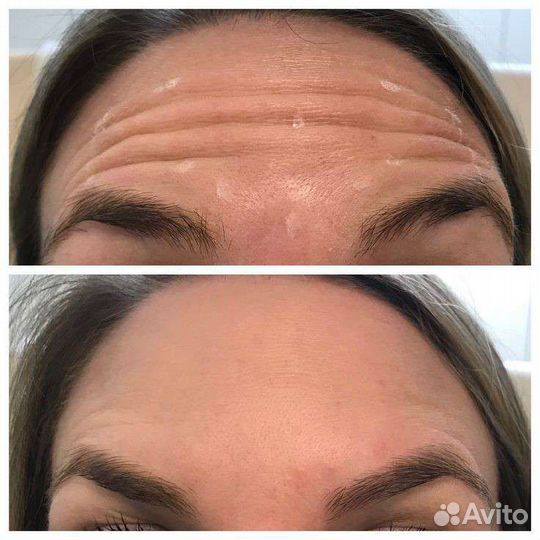 Ботокс лба