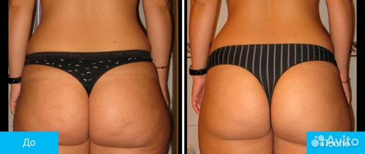 Вакуумный массаж