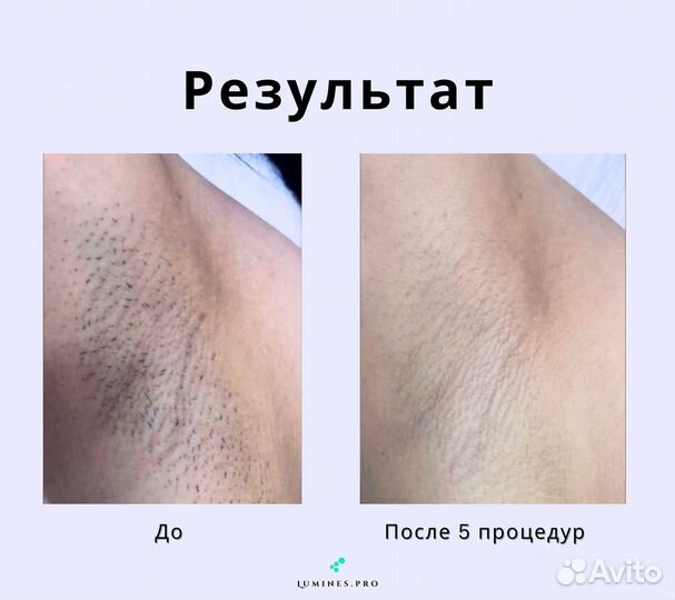 Диодный лазер люминес Max’One 1200в