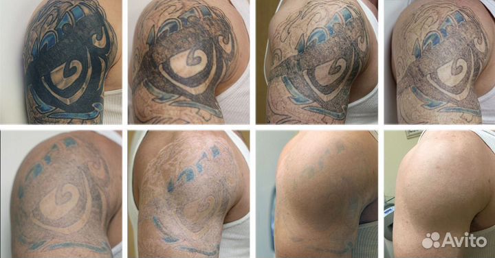 Лазерное удаление тату и ПМ, карбоновый пилинг