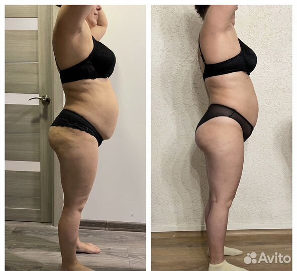 LPG - массаж, кавитация, rf- лифтинг