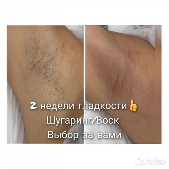 Депиляция/Шугаринг/Воск