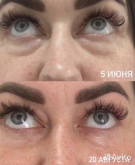 Смас лифтинг