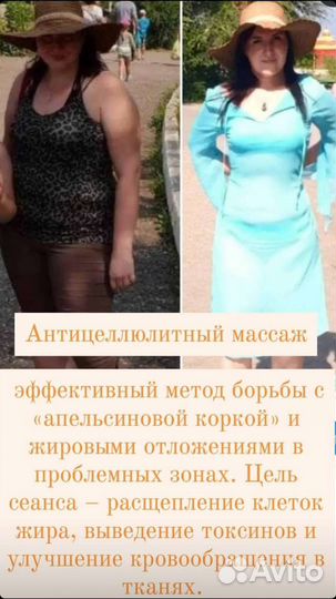 Коррекция фигуры/ скульптурный массаж