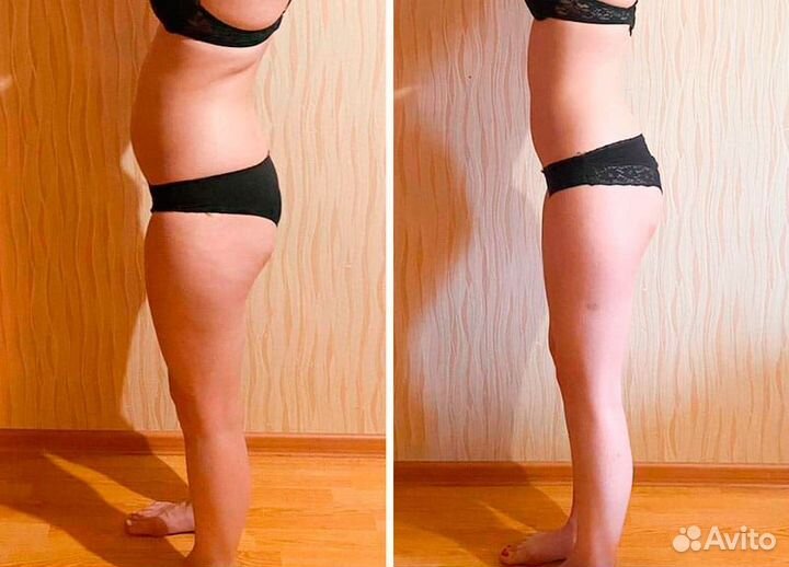 Криолиполиз