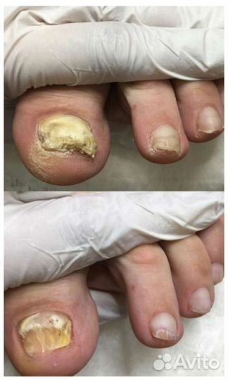 Педикюр любой сложности, титановая нить