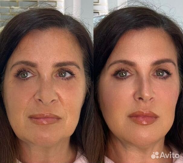 Контурная пластика моделирование лица