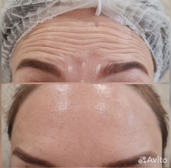 Ботокс для лица