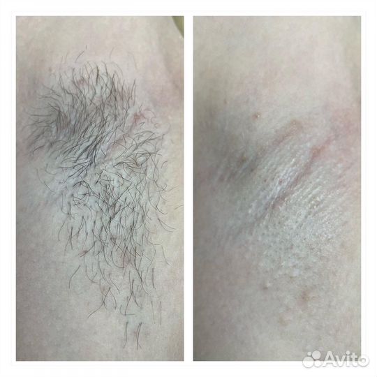 Шугаринг (депиляция сахарной пастой), гелинг