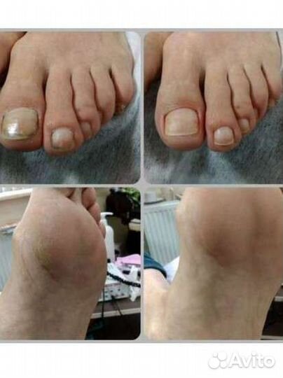 Педикюр, смарт педикюр