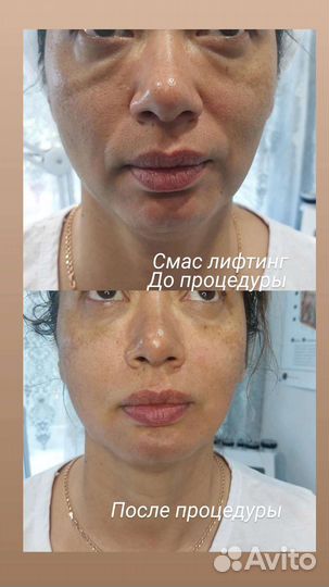 Косметолог. SMAS лифтинг