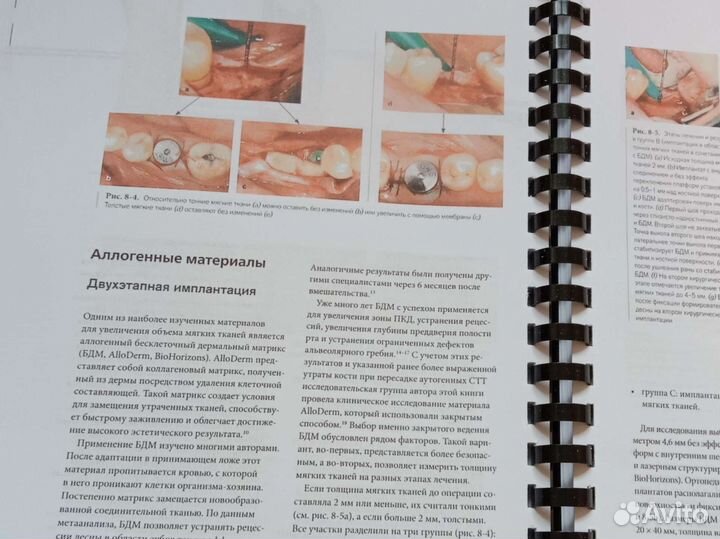 Нулевая утрата кости