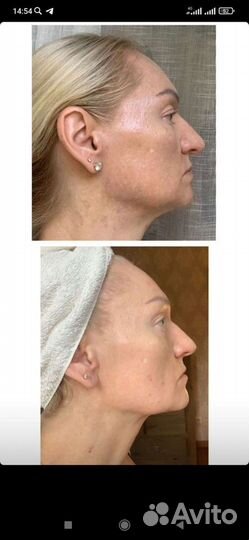 Набор осветляющих кремов evasion depegmentor