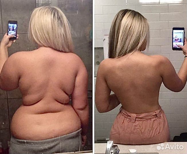 Плоский живот - размер за 1 процедуру в Казани