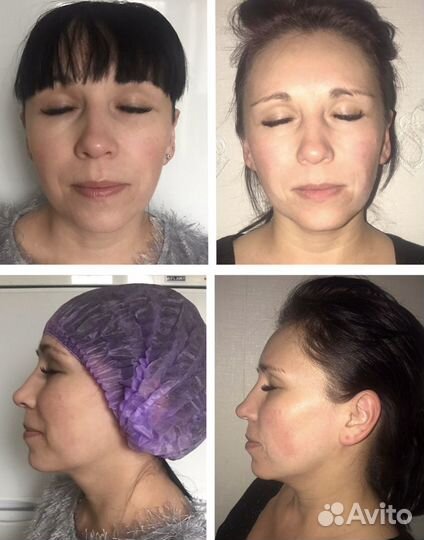 Миофасциальный массаж лица