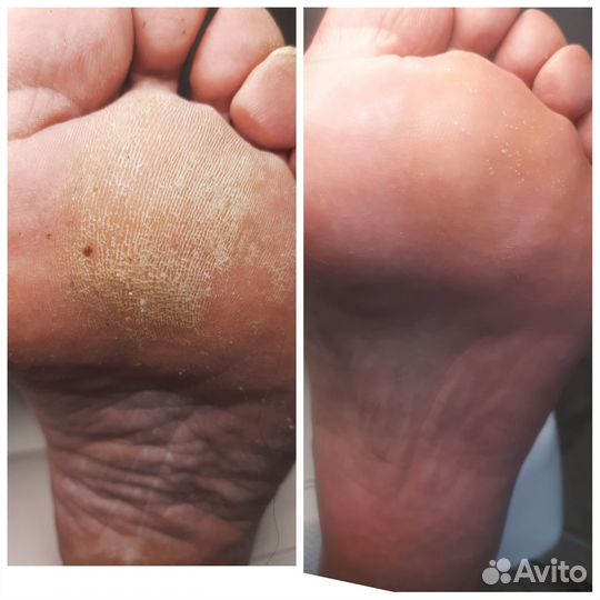 Педикюр подология