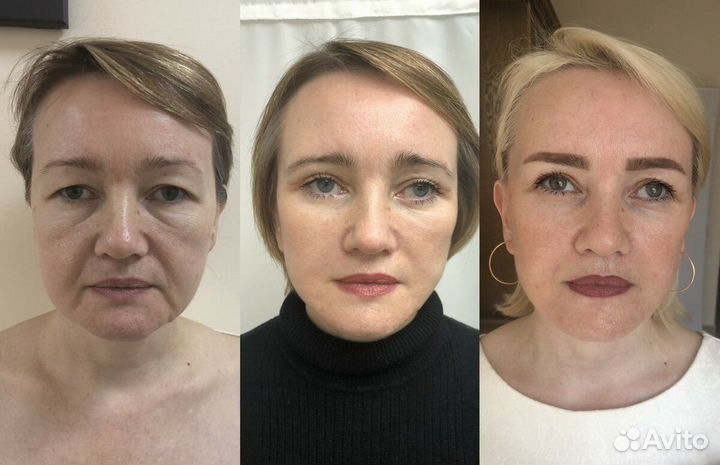 Вакуумно роликовый массаж на аппарате Starvac