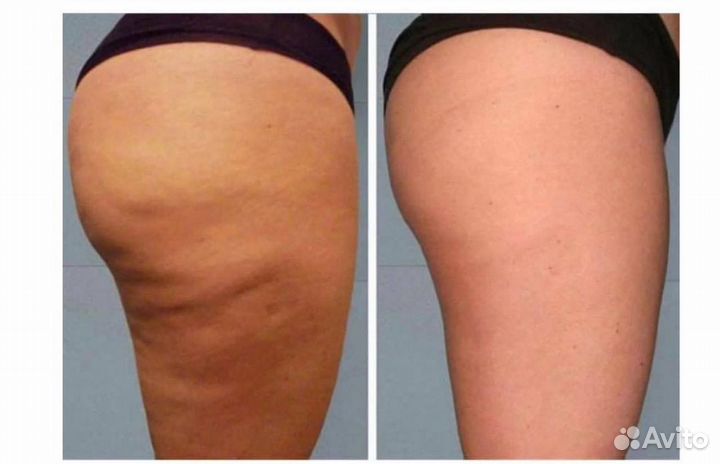 Гидромассаж (подводно-вакуумный массаж)