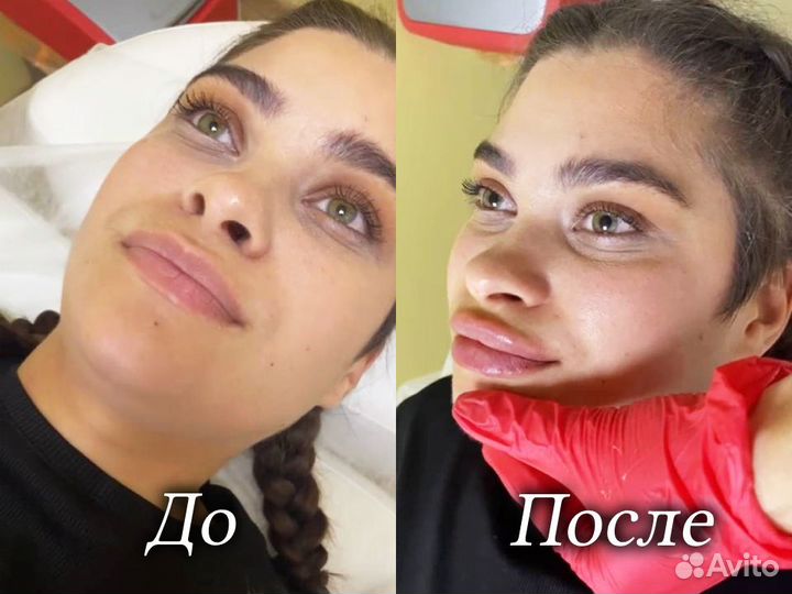 Косметолог. Увеличение губ