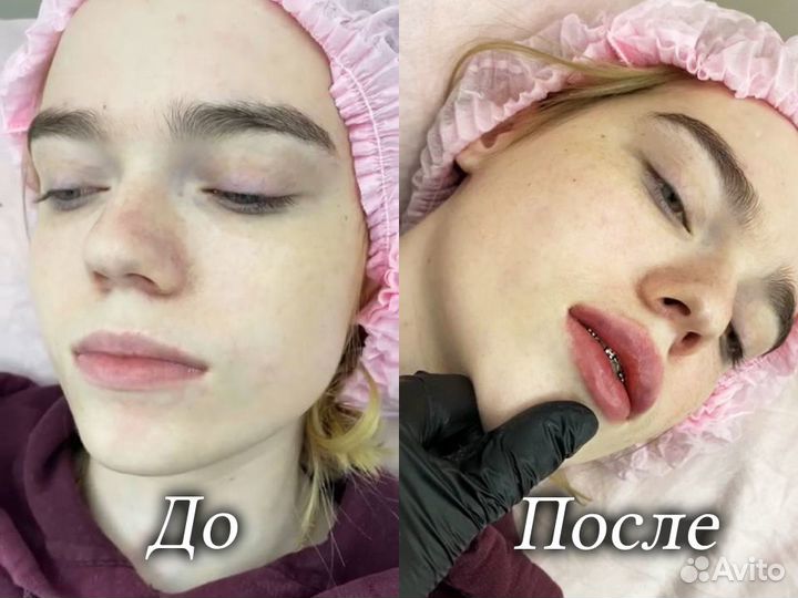 Косметолог. Увеличение губ