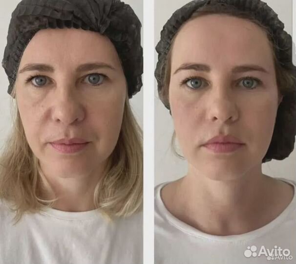 Смас лифтинг, Криолиполиз