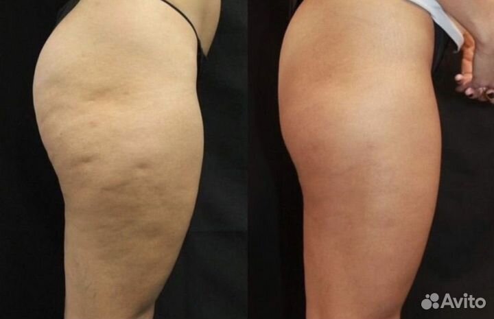 Массаж сферами. Эндо-тепапия лучше LPG