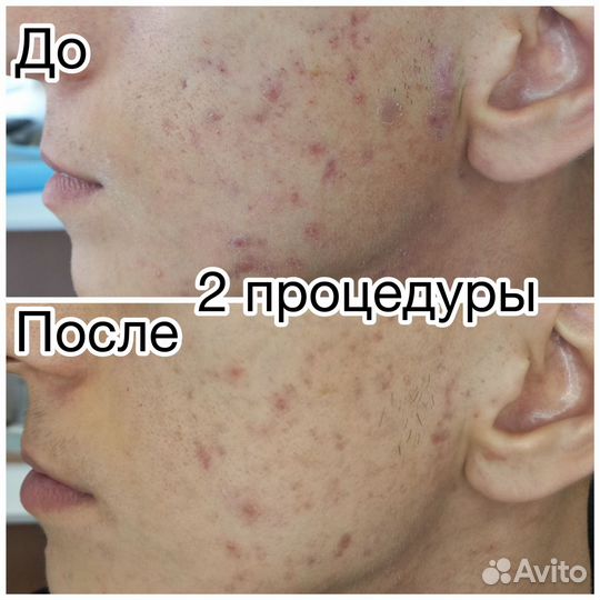Холодная плазма
