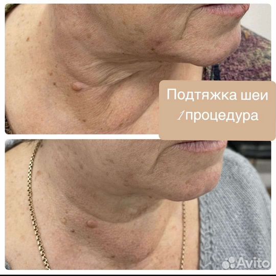 Холодная плазма