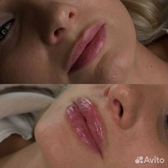 Увеличение губ