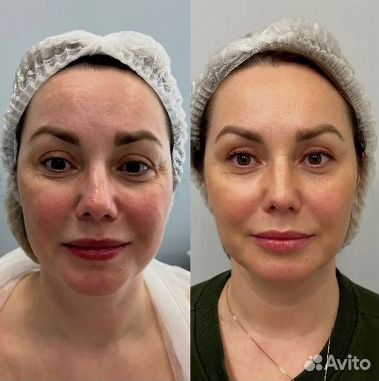 Аппарат РФ лифтинга