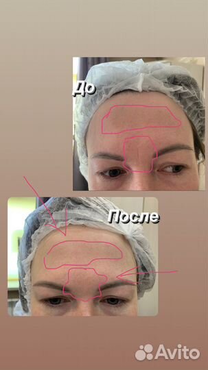 Скульптурный,лимфодренажный,буккальный массаж лица