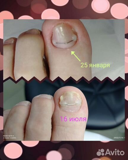 Маникюр, смарт педикюр, титановая нить