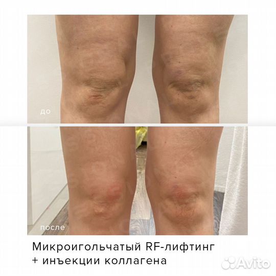 Микроигольчатый РФ лифтинг